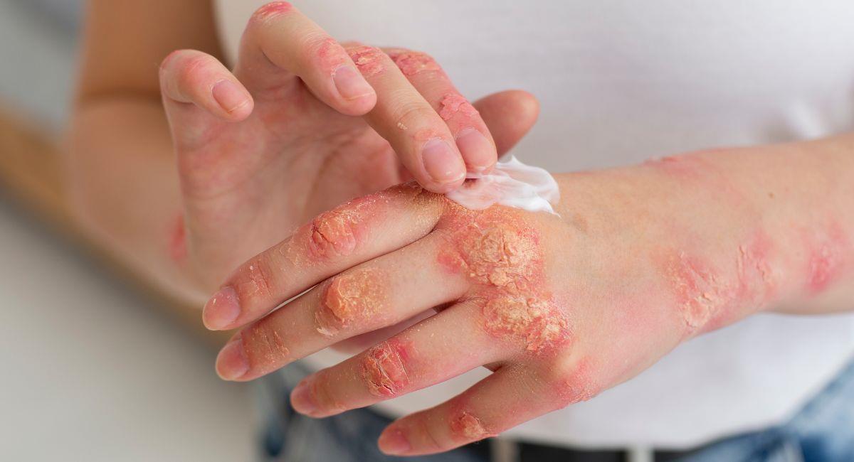 Hongos en la piel: ¿cómo eliminarlos de forma natural?. Foto: Freepik