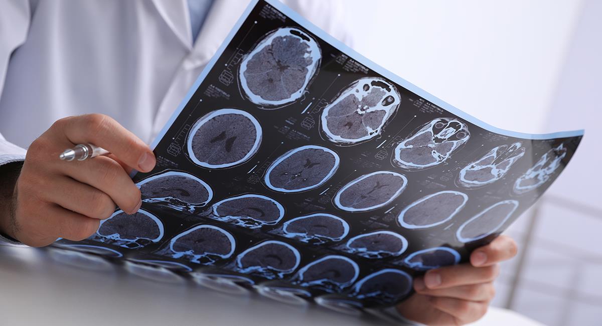Esclerosis múltiple: estudio revela los síntomas tempranos que sirven como alerta. Foto: Shutterstock