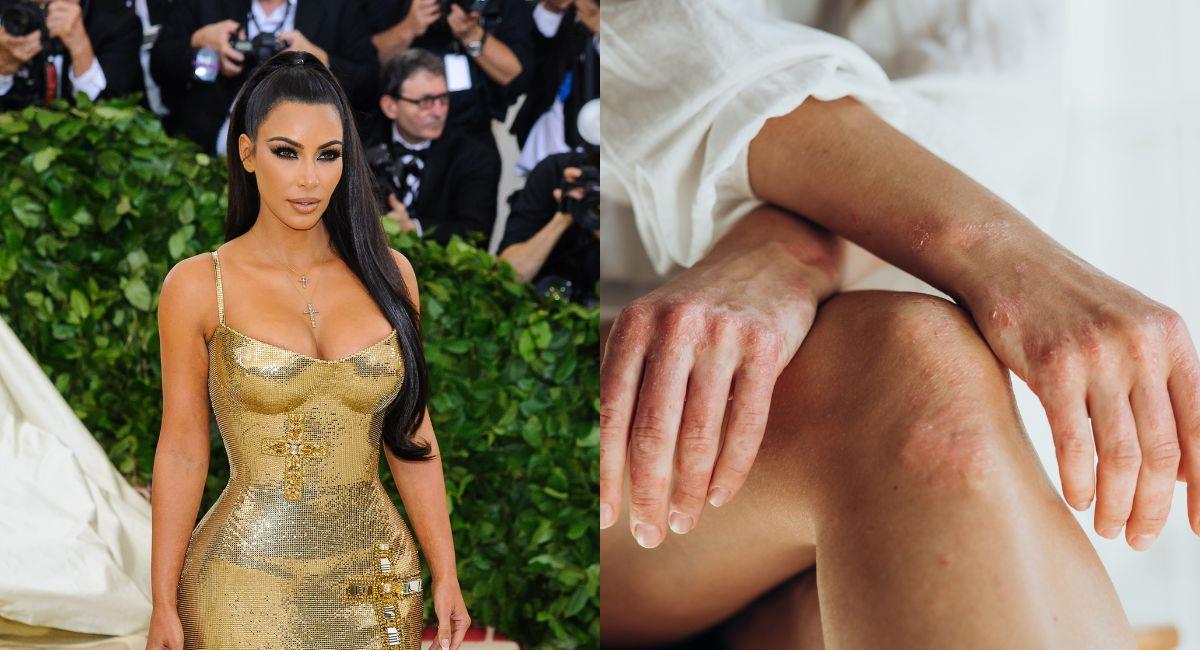 Psoriasis: la enfermedad que sufre Kim Kardashian. Foto: Shutterstock