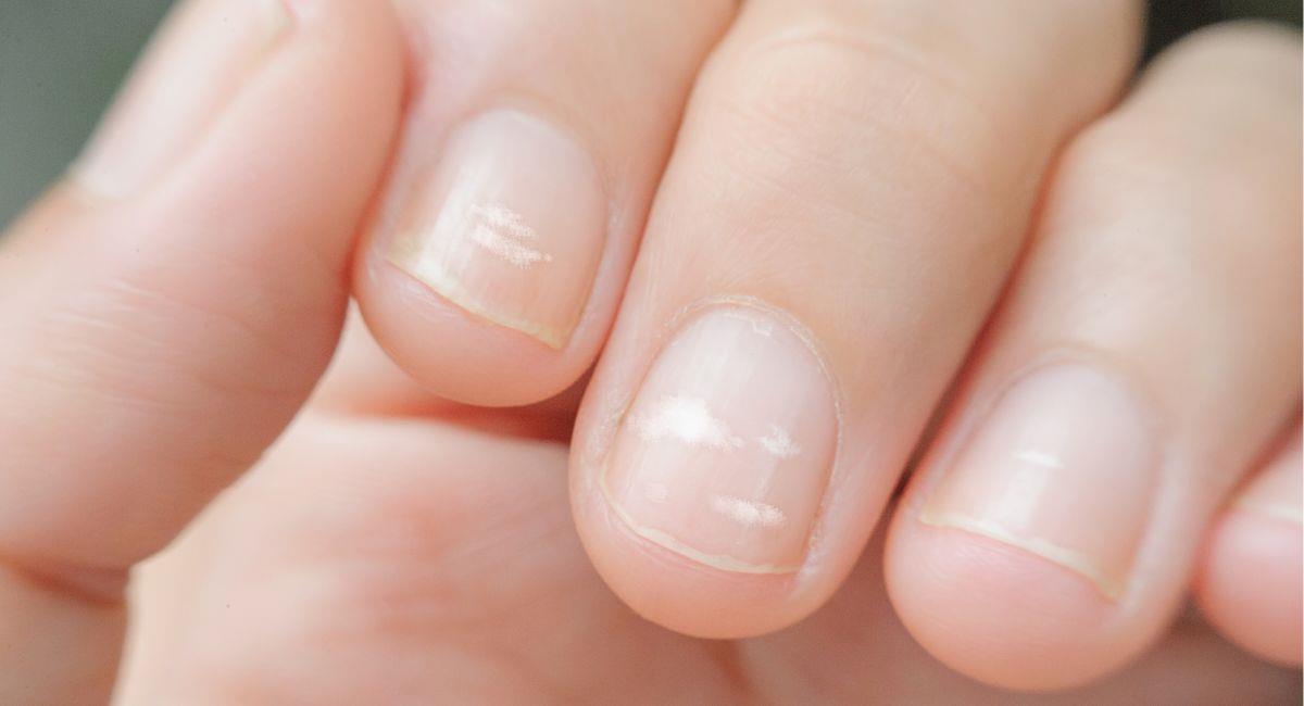 Descubre por qué salen manchas blancas en tus uñas. Foto: Shutterstock