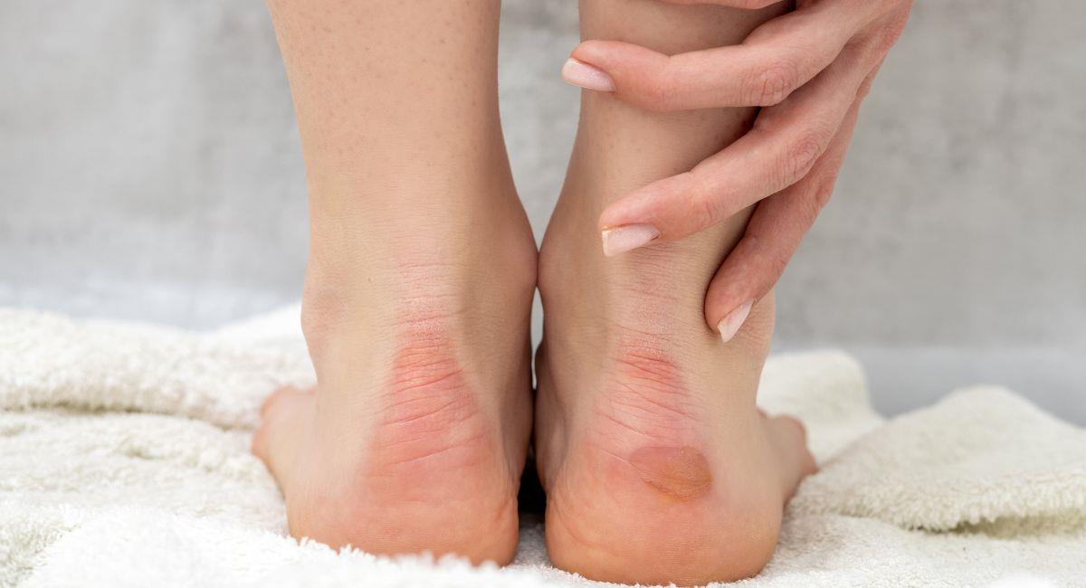 Dos tratamientos efectivos contra los callos en los pies. Foto: Shutterstock
