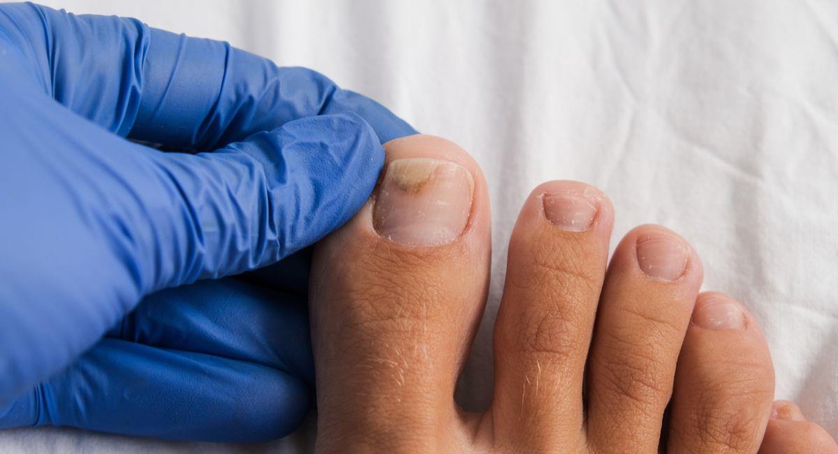 El síntoma de cáncer que se manifiesta en las uñas. Foto: Shutterstock