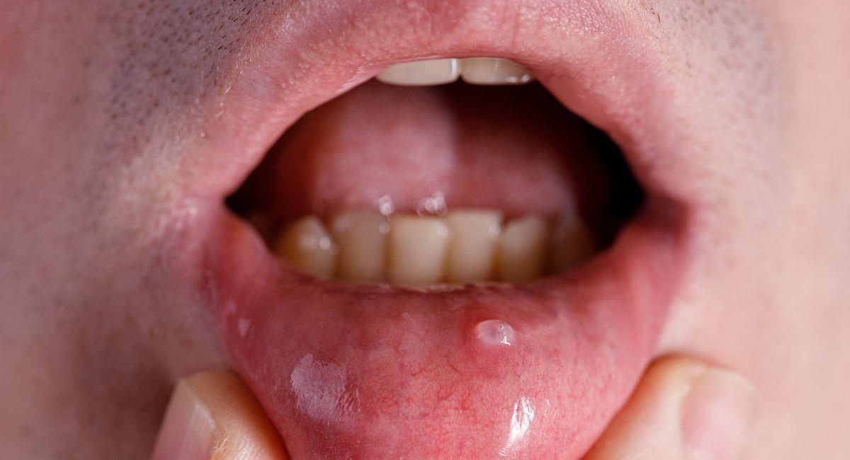 ¿Cuáles son los primeros síntomas del cáncer de boca?. Foto: Shutterstock
