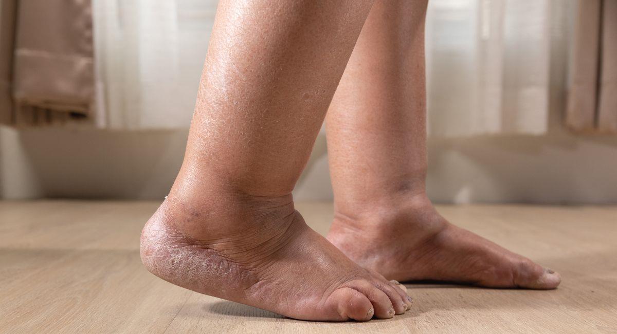 Conoce las causas más comunes de la hinchazón en los tobillos. Foto: Shutterstock