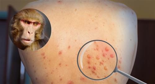 Descubren nueva cepa de la viruela del mono con “potencial pandémico” 